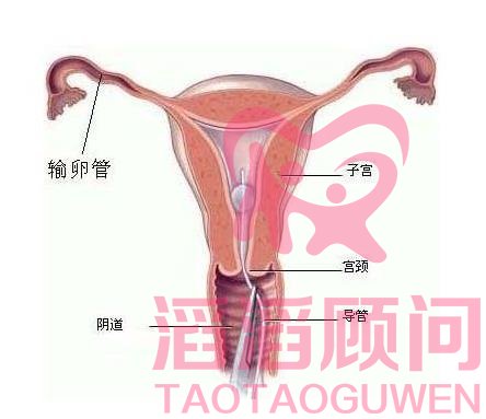 輸卵管兩側(cè)堵了只能做試管嬰兒?jiǎn)?