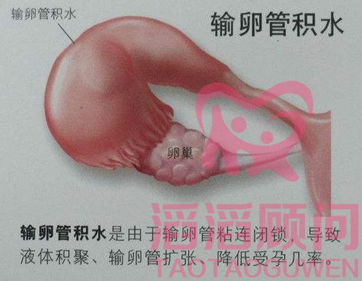 輸卵管一側(cè)有積水能做試管嬰兒?jiǎn)?