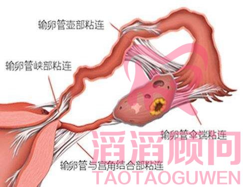 輸卵管傘端粘連做試管嬰兒可以嗎?