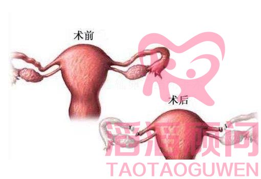 輸卵管切除后多久可以做試管嬰兒?