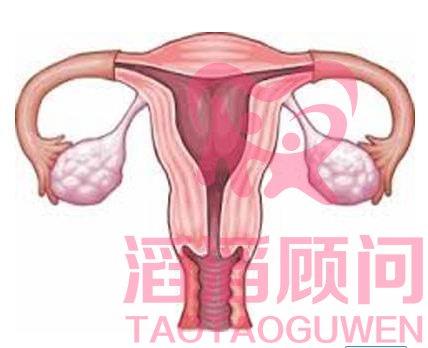 卵巢儲(chǔ)備功能減退怎么做試管嬰兒?