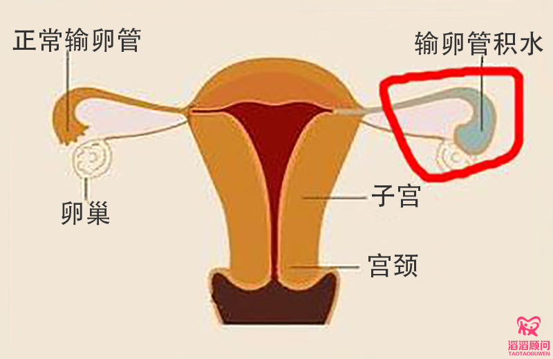 輸卵管積水