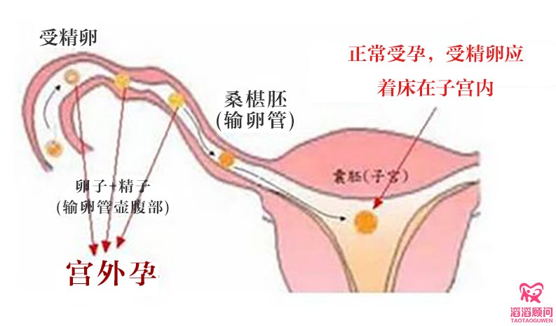 什么是宮外孕