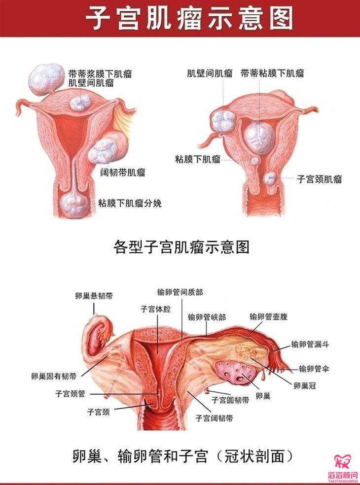 子宮肌瘤