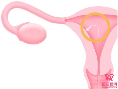 俄羅斯試管嬰兒