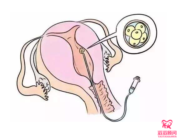 俄羅斯試管嬰兒