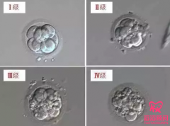 第三代試管嬰兒囊胚檢測(cè)怎么樣？